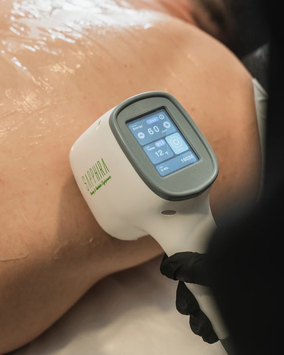 Eliminación de tatuajes, tratamientos láser en Sapphira Privé, clínica estética en San Fernando