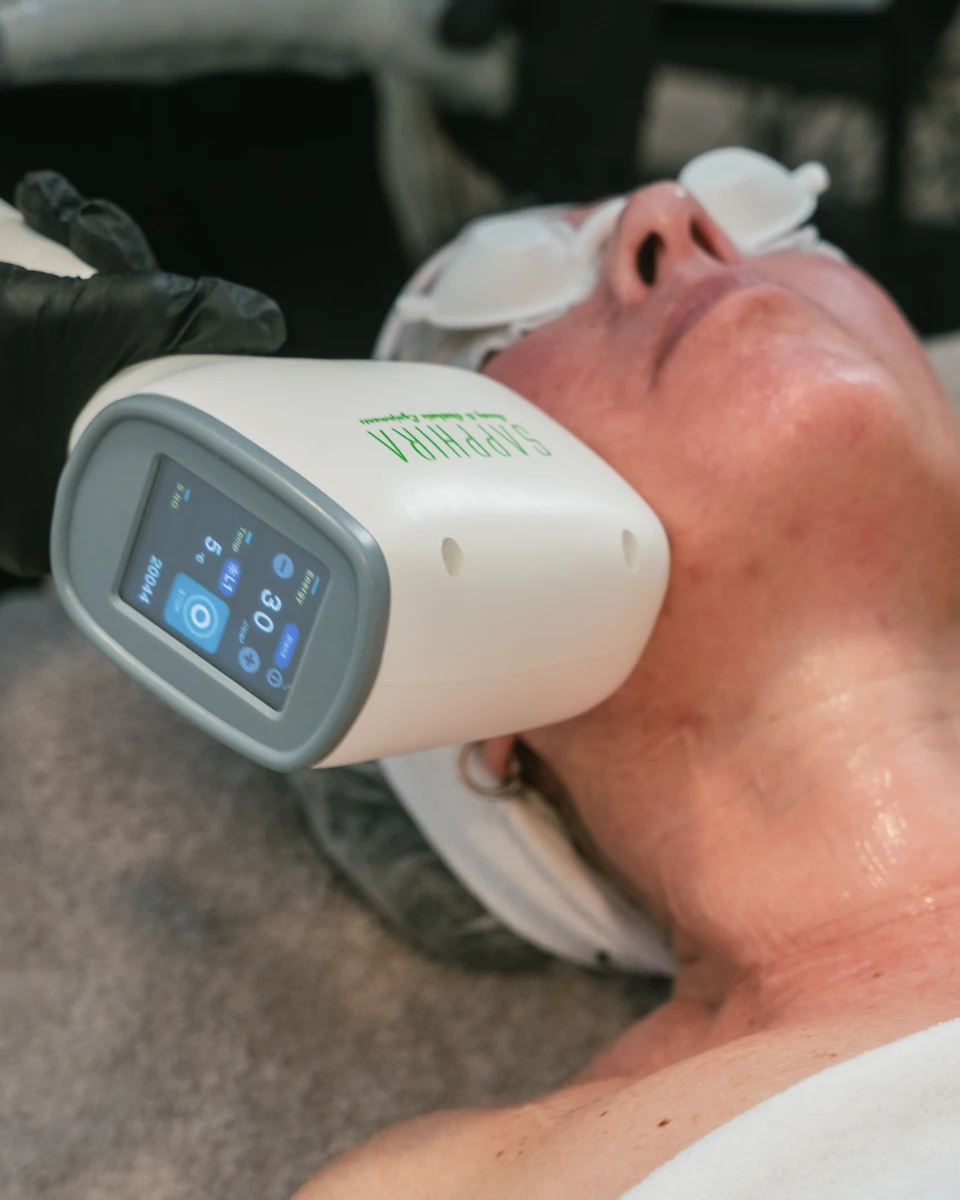 Despigmentación de cejas, tratamientos láser en Sapphira Privé, clínica estética en San Fernando