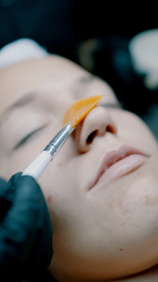 Sapphira Peeling Regenerativo, tratamientos faciales en Sapphira Privé, clínica estética en San Fernando